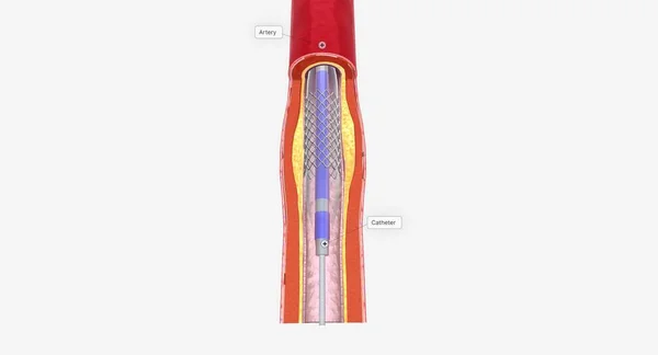 Angioplastia Procedimento Minimamente Invasivo Que Utiliza Cateter Com Ponta Balão — Fotografia de Stock