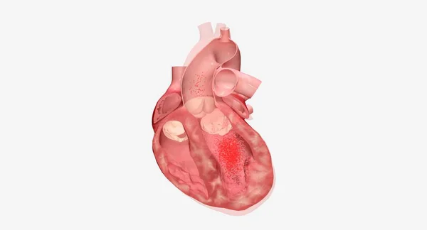 Insuficiência Cardíaca Uma Condição Contínua Que Pode Precisar Vários Medicamentos — Fotografia de Stock