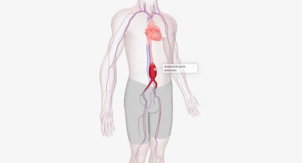 Abdominal aortic aneurysm occurs when the abdominal aorta balloons out due to the weakening of the wall of the artery. 3D rendering