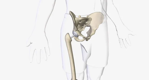 Hofteprotese Kirurgi Personer Med Alvorlige Hofteskader Gjengivelse – stockfoto