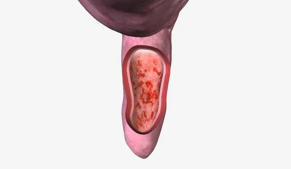 乳腺炎 Proctitis 是直肠的一种炎症 有时会引起不适 粘液或脓液排泄 3D渲染 — 图库照片