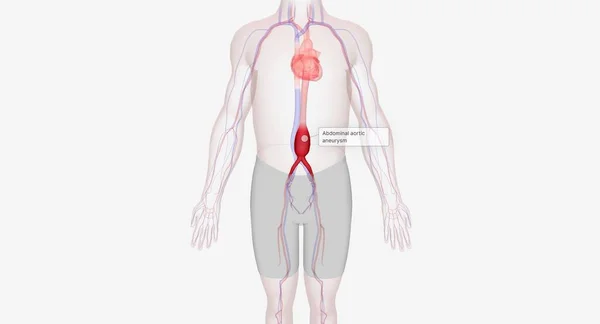 Abdominal aortic aneurysm occurs when the abdominal aorta balloons out due to the weakening of the wall of the artery. 3D rendering