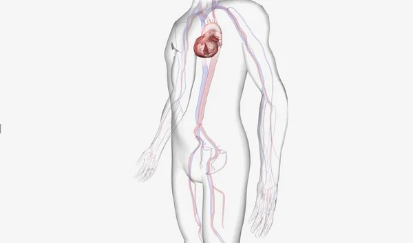 在心源性休克期间 Iabp提供帮助 当心脏无法向身体其他部位输送足够的血液时 就会出现严重的情况 3D渲染 — 图库照片