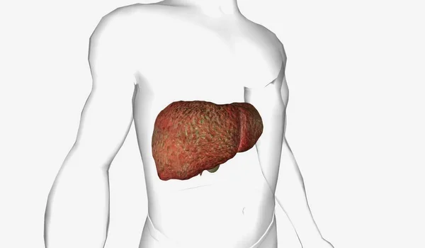 Pbc Характеризується Автоімунним Руйнуванням Малих Середніх Жовчних Протоків Печінці Візуалізація — стокове фото