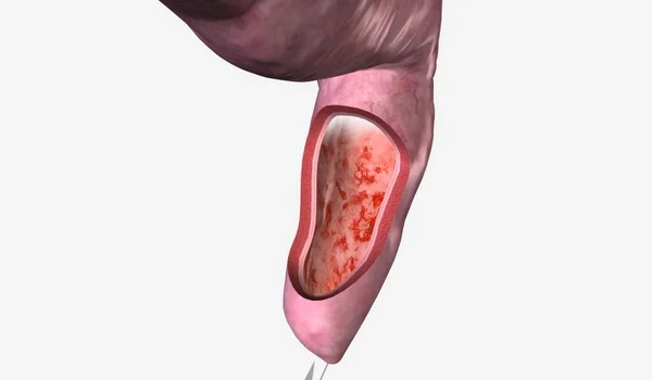 乳腺炎 Proctitis 是直肠的一种炎症 有时会引起不适 粘液或脓液排泄 3D渲染 — 图库照片