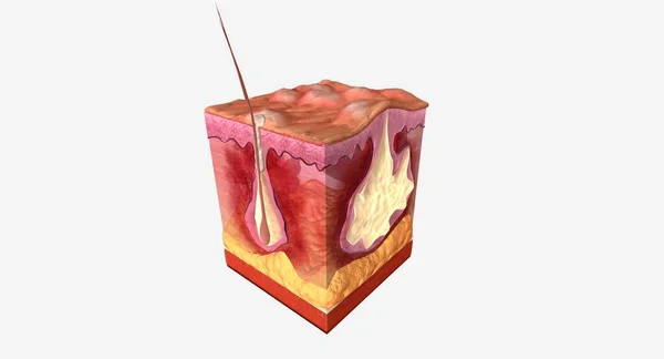 阑尾炎是一种以毛囊肿胀为特征的长期皮肤病 3D渲染 — 图库照片