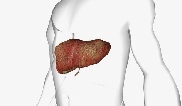 Pbc的特点是肝内中 小胆管自身免疫缺损 3D渲染 — 图库照片