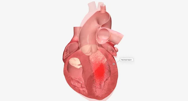 心筋症は心臓の筋肉の病気であり 心臓が体に血液を送ることが困難になります 3Dレンダリング — ストック写真