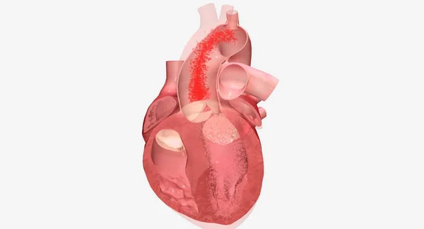 Кардиомиопатия Заболевание Сердечной Мышцы Которое Приводит Тому Сердце Испытывает Трудности — стоковое фото