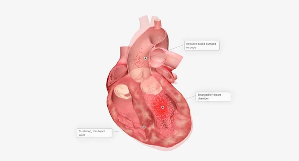 Καρδιακή Ανεπάρκεια Είναι Μια Συνεχιζόμενη Κατάσταση Που Μπορεί Χρειαστεί Πολλά — Φωτογραφία Αρχείου