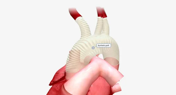 Sentetik Doku Oksijenli Kanın Kalpten Vücudun Geri Kalanına Akmasını Sağlayan — Stok fotoğraf