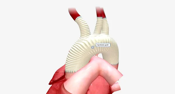 人工合成的移植是一种人造管子 它允许有氧血液从心脏流向身体的其他部位 3D渲染 — 图库照片