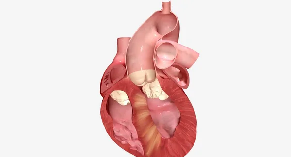 高栄養性心筋症は 心臓の筋肉細胞が大きくなると心室の壁が厚くなる 3Dレンダリング — ストック写真