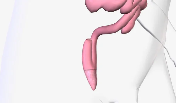 Ileoanal Anastomosis Chirurgie Maakt Het Verwijderen Van Bovenste Onderste Delen — Stockfoto