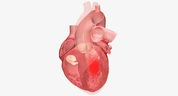 Kardiomyopatie Onemocnění Srdečního Svalu Které Způsobuje Srdce Potíže Pumpováním Krve — Stock fotografie