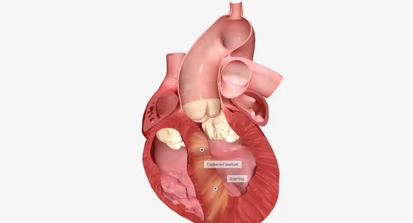 Cardiomyopathie Hypertrophique Produit Lorsque Les Cellules Musculaires Cœur Agrandissent Provoquant — Photo