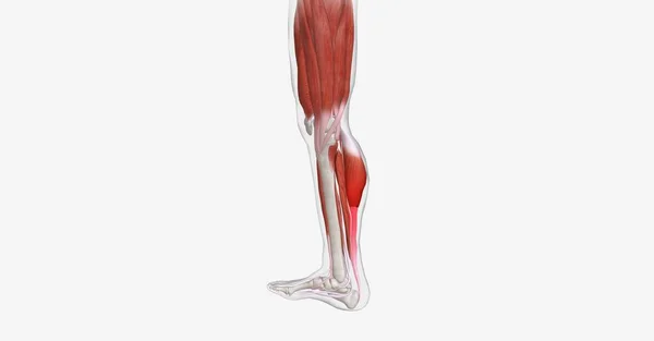 Uma Cãibra Muscular Uma Contração Súbita Dolorosa Involuntária Mais Músculos — Fotografia de Stock