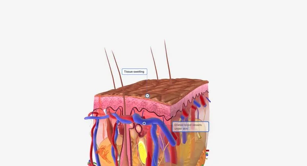 Angioedema Swelling Dermis Subcutaneous Tissue Anaphylaxis Histamine Release Vascular Edema — Fotografia de Stock