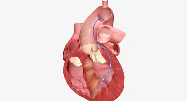 これは心臓組織のいくつかが縮小し 死ぬ原因となります 残りの瘢痕組織は 拡大した敗血症よりも薄いです 3Dレンダリング — ストック写真