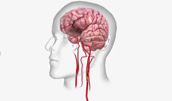 Perda Suprimento Sangue Priva Cérebro Oxigênio Que Pode Levar Morte — Fotografia de Stock