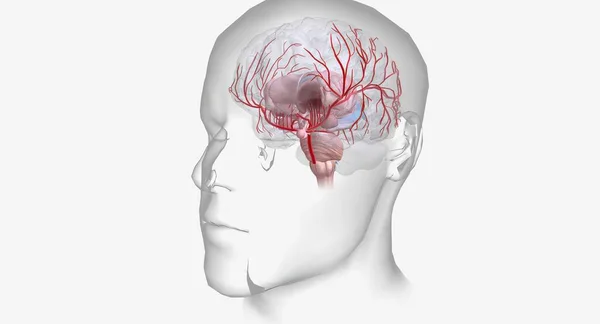 Геморрагический Инсульт Является Неотложным Заболеванием Характеризующимся Кровотечением Внутри Поверхности Мозга — стоковое фото