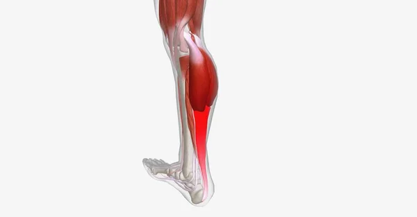 筋肉のけいれんは 痛みを伴う 1つ以上の筋肉の不随意収縮です 3Dレンダリング — ストック写真