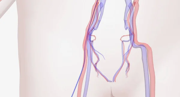 一个细管 被插入到腿的一个大血管中 导管被引导到动脉瘤的部位 支架的移植手术将沿着导管进行 3D渲染 — 图库照片