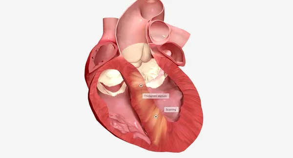 stock image Hypertrophic cardiomyopathy occurs when the muscle cells of the heart enlarge causing the walls of ventricles to thicken. 3D Render