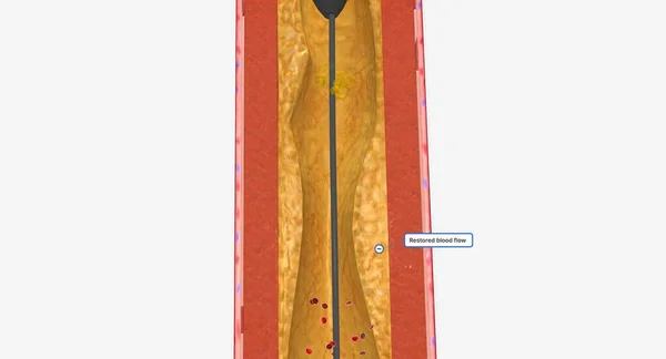 Atherectomy是一种微创的手术 利用末端带有钻头的导管摘除斑块 3D渲染 — 图库照片