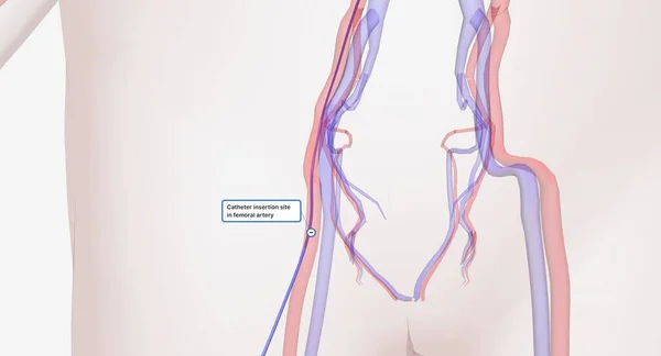 一个细管 被插入到腿的一个大血管中 导管被引导到动脉瘤的部位 支架的移植手术将沿着导管进行 3D渲染 — 图库照片