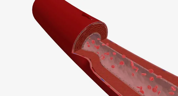 動脈切開は 動脈の壁に行われる切断または開口部です 3Dレンダリング — ストック写真
