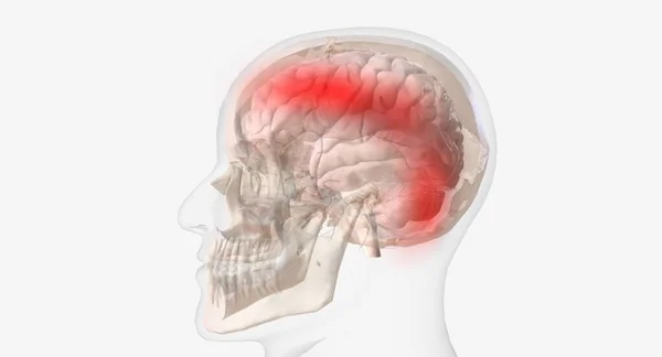 Headaches Known Tension Type Affect Forehead Temples Back Head Rendering — Stock Photo, Image