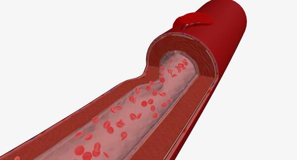 An arteriotomy is a cut or opening that is made into the wall of an artery. 3D rendering