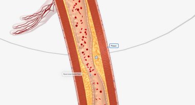 Alt ekstremitedeki daralmış kan damarı alt ekstremitasyon arteriyel müdahale anjiyoplasti, stent ya da atherektomi olabilir. 3B görüntüleme