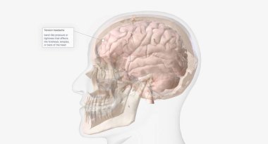 Gerilim tipi olarak bilinen baş ağrıları, alnını, şakaklarını ve başının arkasını etkiler.