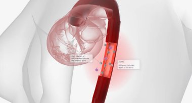 High volumes of lymphocytes, macrophages, and other immune cells infiltrate the inflamed aorta. 3D rendering