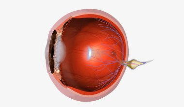 Presbyopia, nesneleri yakından görme yetersizliğiyle karakterize edilen dejeneratif bir göz durumudur. 3B görüntüleme