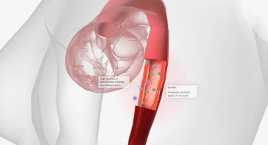 High volumes of lymphocytes, macrophages, and other immune cells infiltrate the inflamed aorta. 3D rendering
