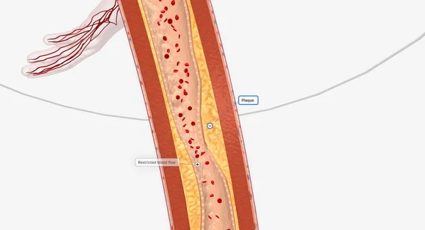 Narrowed Blood Vessel Lower Extremity Lower Extremity Arterial Intervention May — 스톡 사진