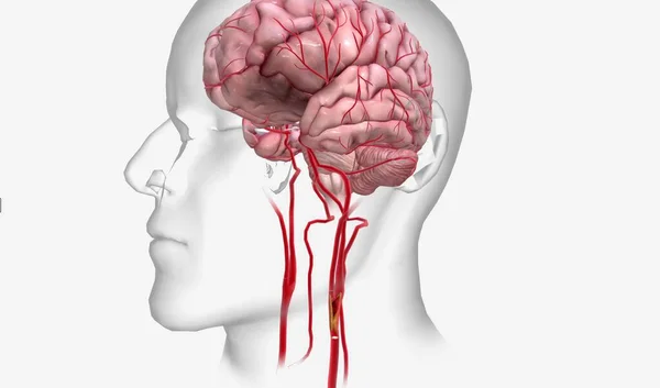 Loss Blood Supply Deprives Brain Oxygen Which Can Lead Brain — Stock Photo, Image