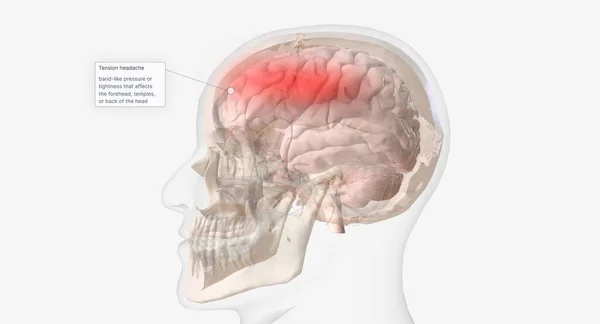 Headaches Known Tension Type Affect Forehead Temples Back Head Rendering — Stock Photo, Image