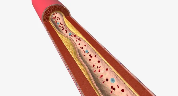 高甘油三酯血症是一种以血液中甘油三酯含量高为特征的常见病 3D渲染 — 图库照片