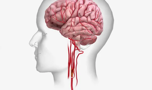 Perdita Afflusso Sangue Priva Cervello Ossigeno Che Può Portare Alla — Foto Stock