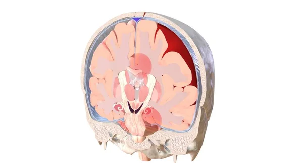 Tipo Comune Ernia Cerebrale Caratterizzata Tessuto Cerebrale Movimento Sotto Piega — Foto Stock