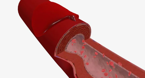 动脉切开术是在动脉壁上进行的一种切口或开口 3D渲染 — 图库照片