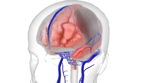 Leads Subdural Bleeding Hemorrhaging Blood Collects Dura Mater Arachnoid Mater — Stock Photo, Image
