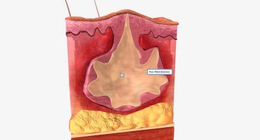 Hidradenitis suppurativa, saç foliküllerinin şişmesiyle karakterize edilen uzun vadeli bir cilt hastalığıdır. 3B görüntüleme