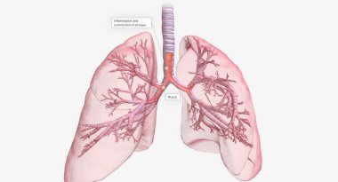 Inflammation and constriction of airways 3D rendering
