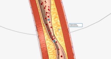 Atherosclerosis is the plaque buildup in the walls of the arteries. 3D rendering
