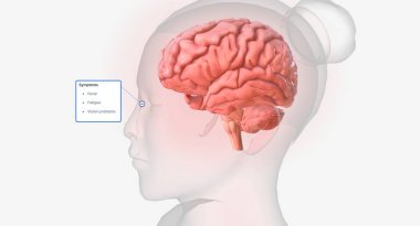 Aortitis is a rare condition characterized by inflammation of the aorta. 3D rendering